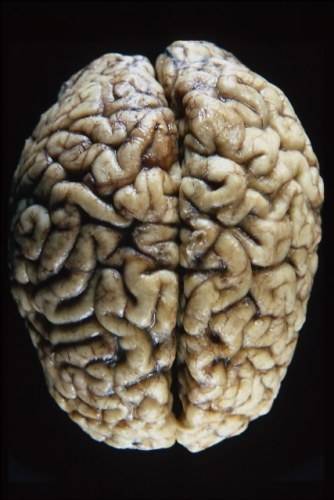 CÉREBRO BIPOLAR