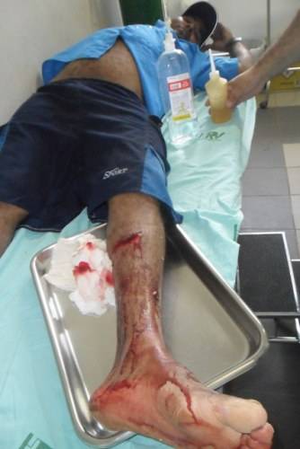 Vaso sanitário explode e pedreiro sofre corte profundo na perna em Vilhena