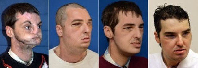 TRANSPLANTE DE FACE