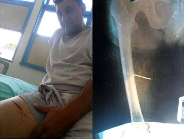 Médicos de Vilhena vão operar homem que ficou com arame cravado no corpo