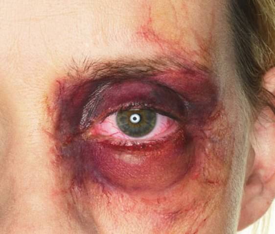 MARIA DA PENHA: CORRETOR SOFRE FRATURA AO SER AGREDIDO PELA ESPOSA