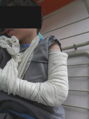 Brincadeira entre alunos de escola municipal deixa menino com braço fraturado
