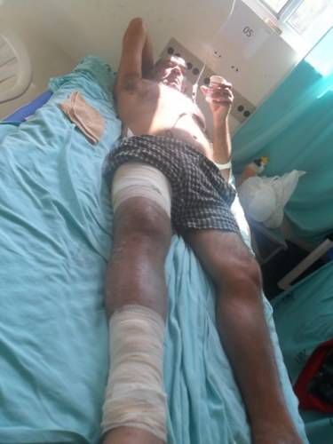 Morador de Colorado cai de escada, sofre fraturas e é operado em Vilhena