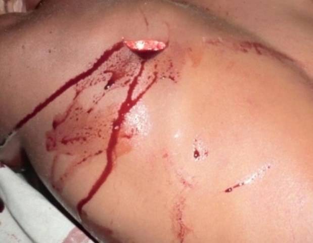 Vilhena: garoto de 16 anos leva facada nas costas, mas não dá nome do agressor