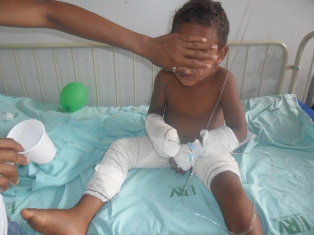 Menino de 4 anos tem 20% do corpo queimado por álcool em Colorado do Oeste