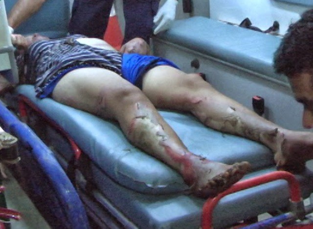 Mulher sofre queimaduras graves após receber descarga elétrica pelo celular