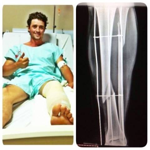 Ex-BBB Fael sofre acidente e passa por cirurgia: