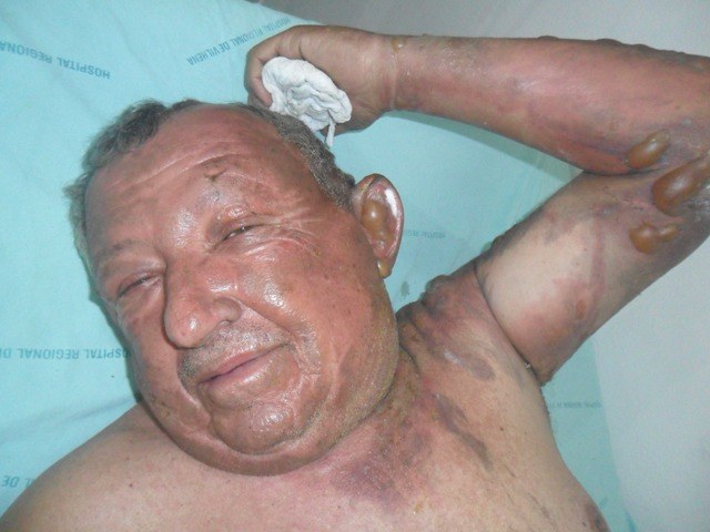 Carreta pega fogo e motorista com queimaduras de 2º grau é internado em Vilhena