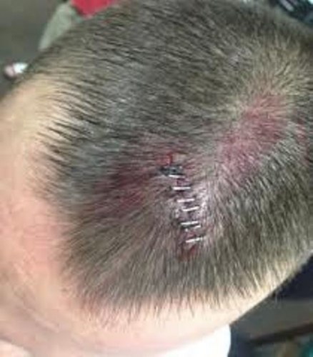 Desconfiado da mulher, homem provoca corte na própria cabeça durante festa
