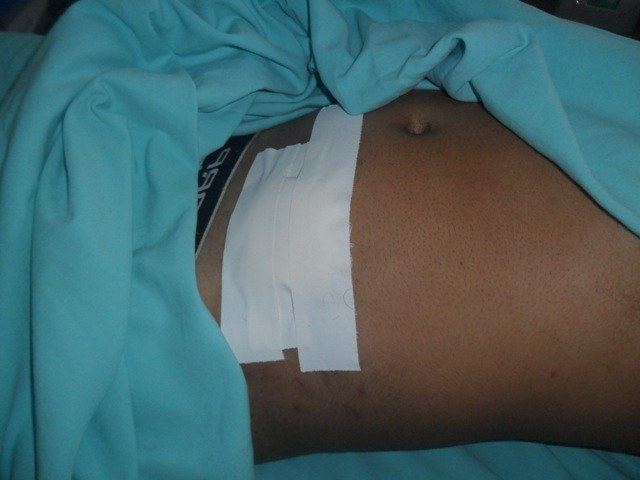 Rapaz de 18 anos esfaqueado durante festa em Corumbiara é operado em Vilhena