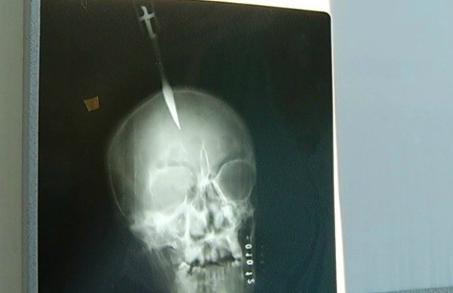 Cerejeiras: policial tenta evitar briga e fica com canivete cravado no crânio