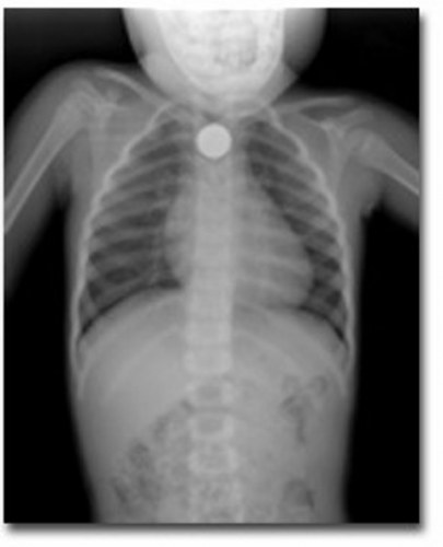 Menina de 5 anos engole bolinha de gude e é internada em hospital de Vilhena