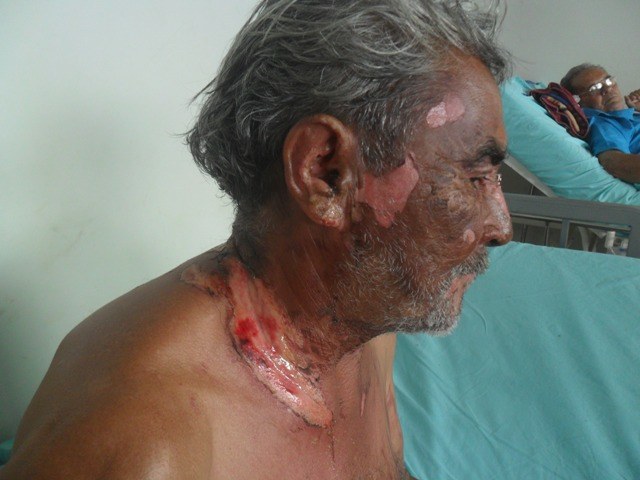 Mulher atira panela de sopa em idoso e provoca queimaduras de segundo grau