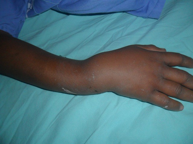 Brincando com irmão, menino de 7 anos fratura braço no centro de Vilhena