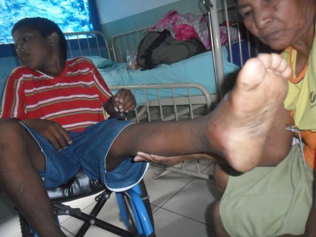 Indiozinho de 10 anos é atacado por jararaca e vem parar no Hospital Regional
