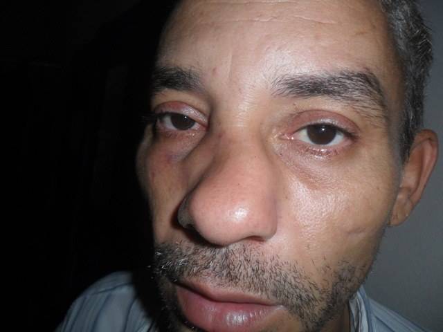 Vilhena: pedreiro tem nariz fraturado ao tentar impedir agressão contra mulher 