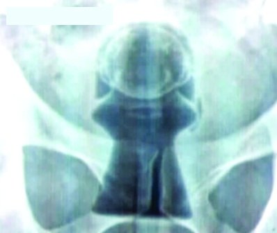 Em cidade da região, índio com frasco de desodorante no ânus passa por cirurgia