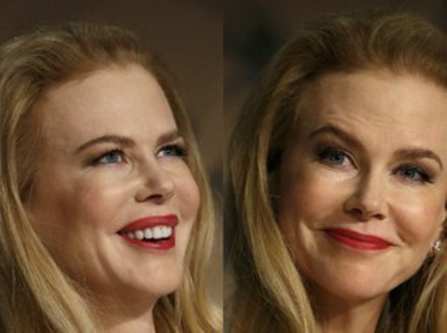 Nicole Kidman aparece com lábios inchados e rosto quase irreconhecível 