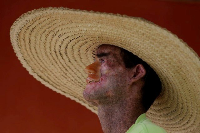 XERODERMA PIGMENTOSO