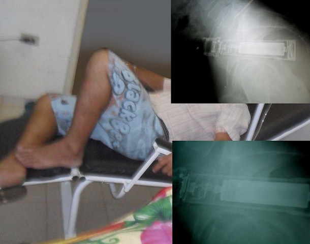 Caminhoneiro com lanterna no ânus será operado em hospital de Vilhena