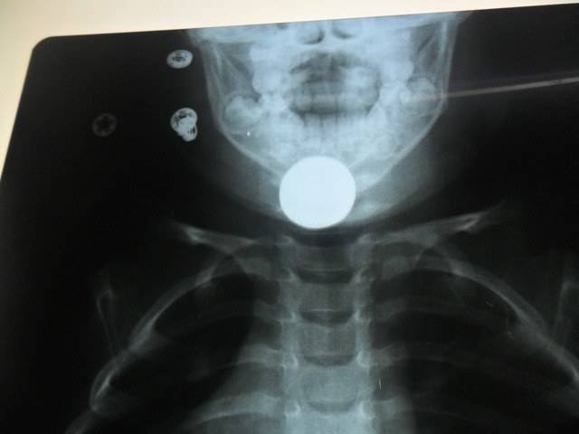 Criança de 2 anos que engoliu moeda em Cerejeiras é encaminhada para Vilhena