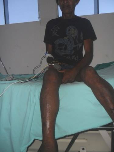 Índio picado por cobra no MT é atendido no Hospital Regional de Vilhena