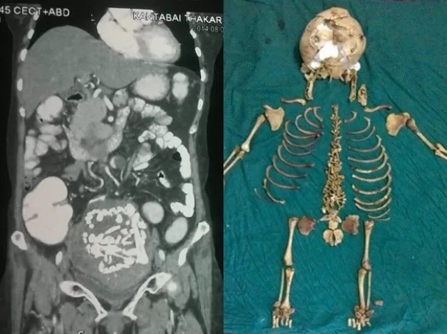 ALOJADO ENTRE OS INTESTINOS