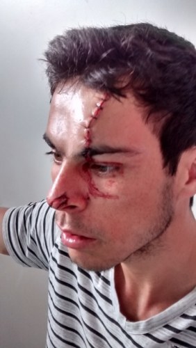 Colorado do Oeste: rapaz de 22 anos tem rosto atingido por motosserra 