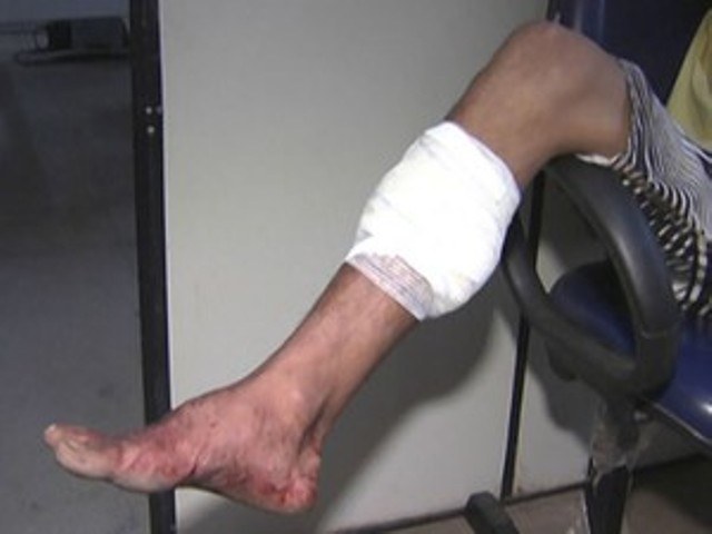 Homem tem perna fraturada após ser baleado por desconhecidos em Vilhena