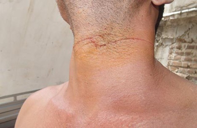 Homem de 32 anos tenta suicídio em Cerejeiras por causa de problemas conjugais