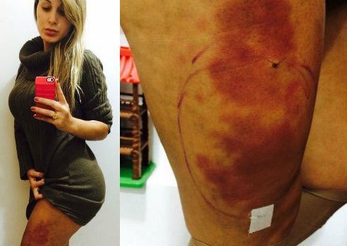 Andressa Urach pode perder a perna, diz especialista