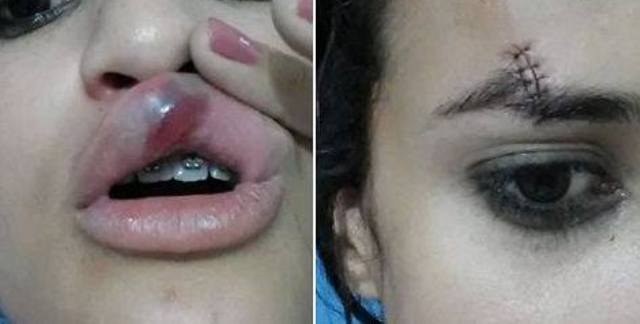 Modelo de 21 anos fica ferida durante trote universitário em Vilhena