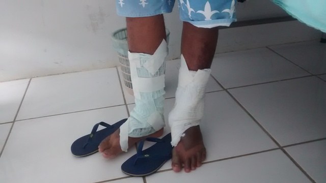 Mecânico sofre queimadura de segundo grau ao preparar jantar em Cerejeiras