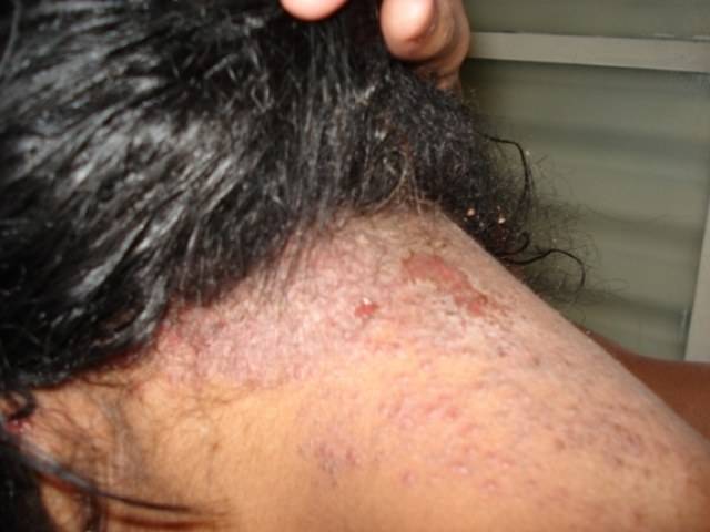 Na cidade de Cerejeiras, homem ateia fogo no corpo de mulher de 35 anos