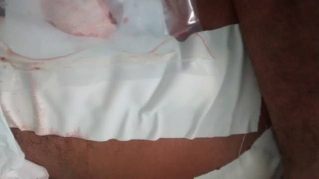 Homem tem vísceras expostas após ataque com “caco de garrafa” em Vilhena
