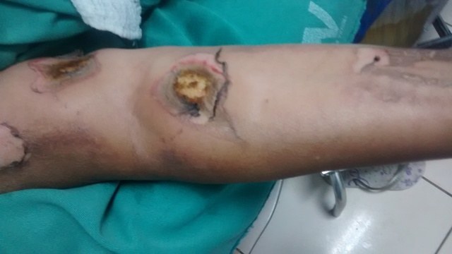 Vilhena: mulher sobrevive milagrosamente a descarga elétrica em celular