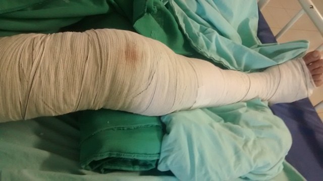  Funcionário de cerâmica em Cabixi sofre fratura exposta e é atendido em Vilhena