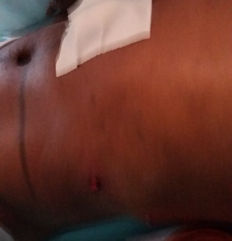 Rapaz de 23 anos baleado por comerciante em Corumbiara está na UTI de Vilhena