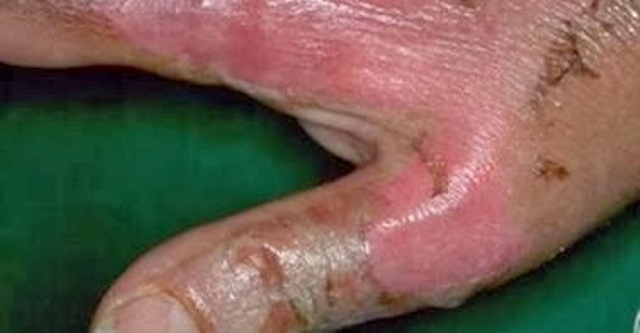Homem de 70 anos morre após atear fogo ao próprio corpo na cidade de Cerejeiras