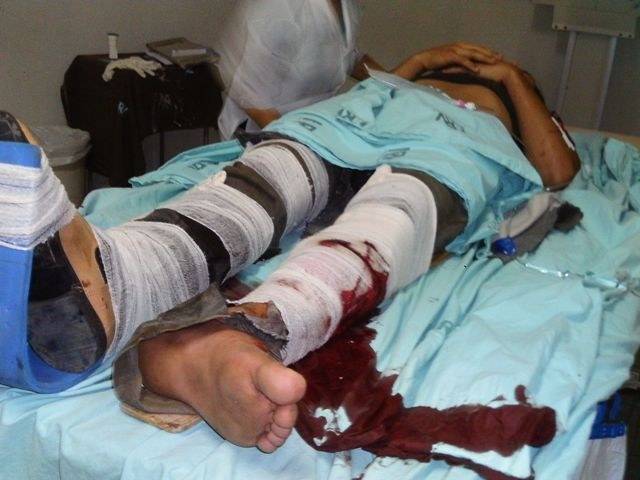 JOVEM DE 18 ANOS É ATROPELADO POR MOTO NA 364 E SOFRE FRATURA EXPOSTA