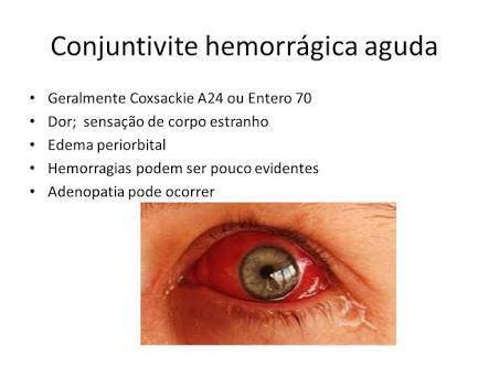 Surto de conjuntivite ataca Vilhena: casos aumentaram até 20 vezes nos últimos 30 dias