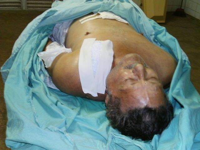 APÓS UMA SEMANA DE INTERNAÇÃO, IDOSO ATROPELADO MORRE NA UTI