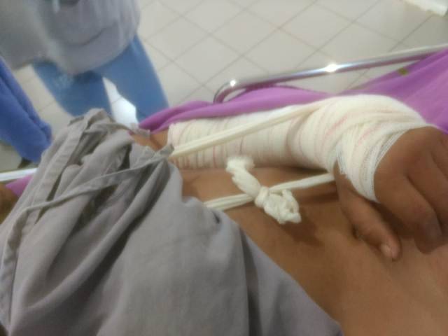 Vilhena: com cirurgia de emergência, médicos evitam que homem tenha braço amputado após acidente de trabalho