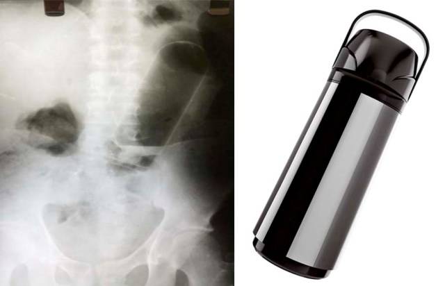 Em cidade do interior de Rondônia, mulher introduz garrafa térmica no ânus do namorado e objeto “escapole”