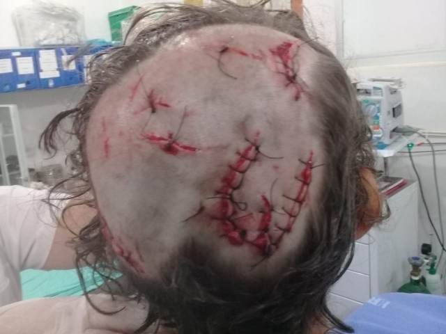 Menina de 8 anos é atacada por pit bull em Vilhena; homem que passava pelo local conseguiu salvá-la