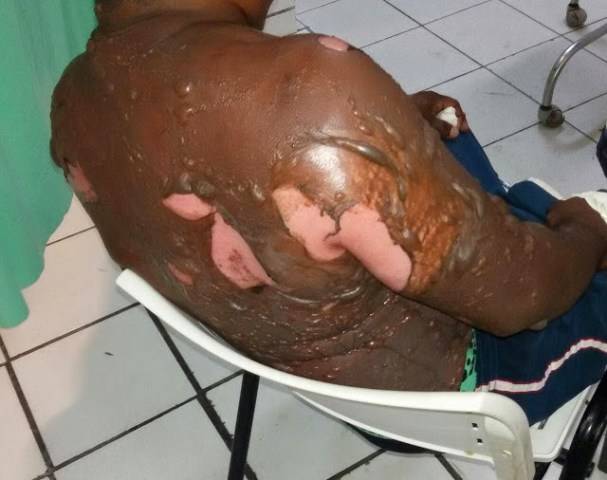 Após briga homoafetiva, homem joga gasolina e ateia fogo ao corpo do companheiro em Vilhena