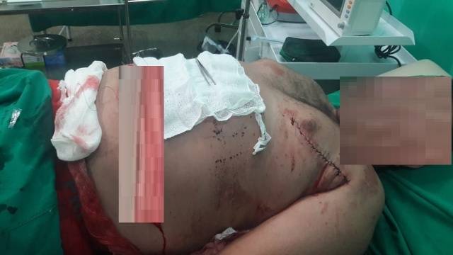 Chupinguaia: homem tenta separar briga em bar do distrito de Novo Plano e acaba ferido