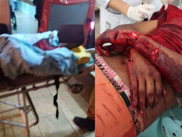 Mesmo baleado, idoso de 61 anos reage a assalto e fere atirador a golpes de facão; suspeito foi preso
