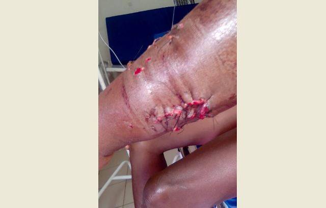 Marido já foi liberado, mas mulher atacada por pitbull segue internada em Vilhena; policiais deram 7 tiros no animal