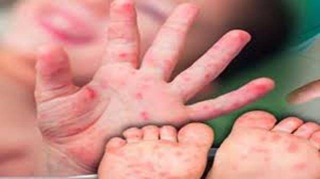 Cidade de Rondônia registra pelo menos 100 casos da doença mão-pé-boca; crianças são as mais atingidas